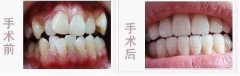 我做了第三代借卵试管婴儿!谈一谈高龄做借卵试管婴儿的风险!