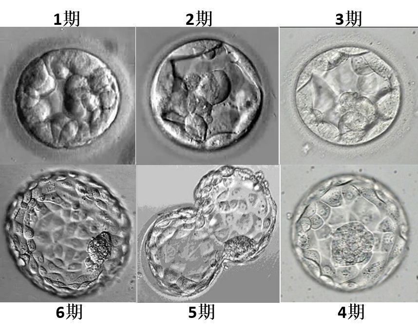 一、二、三代不同!邵逸夫借卵做代生三代试管的费用明细，花在这3个地方的钱