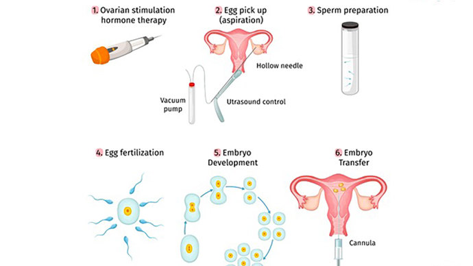 结扎的女人可以做试管婴儿吗