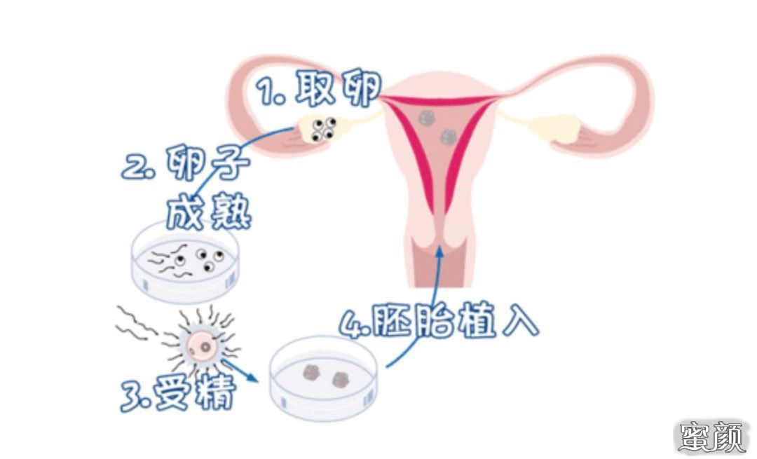 单侧输卵管通畅人授好还是试管好+什么是人授